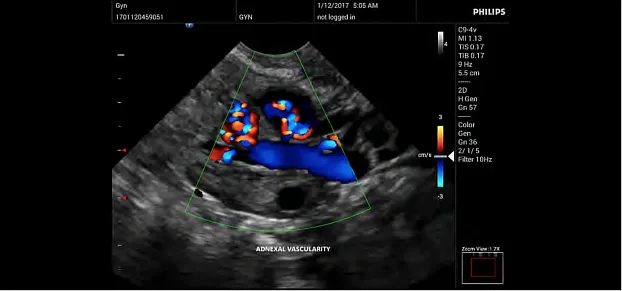 Клинические изображения Philips InnoSight ультразвуковой аппарат