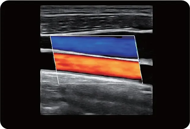 Клинические изображения УЗИ аппарат Chison Qbit 9 New Matrix