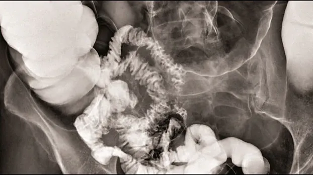 Клинические изображения Цифровой рентгеноcкопический аппарат GE Discovery RF180