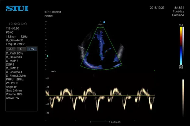 Клинические изображения Аппарат УЗИ SIUI Apogee 3500