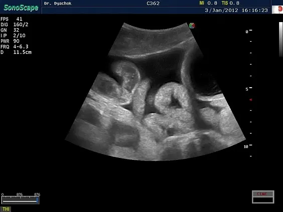 Клинические изображения Sonoscape S35 ультразвуковой аппарат